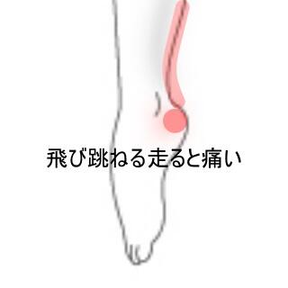 足首ふくらはぎの痛み
