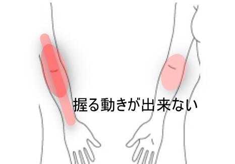 腕の痛み