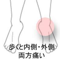 捻挫後の痛み