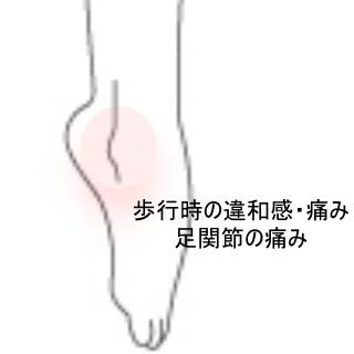 足首の痛み