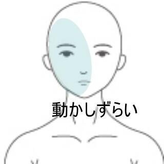 顔面神経麻痺