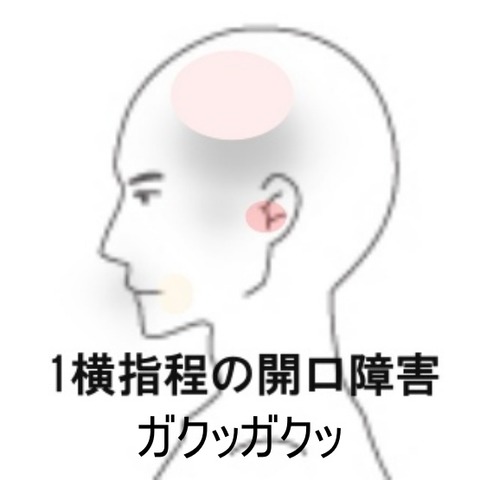 顎関節症1
