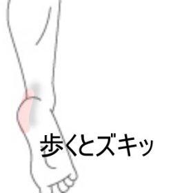 踵の痛み