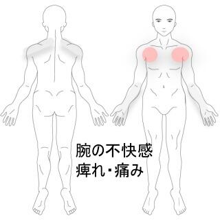 胸郭出口症候群