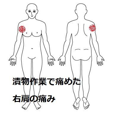 右肩の痛み