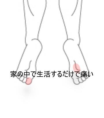 足裏の痛み