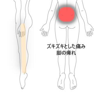 腰の痛みと脚の痺れ