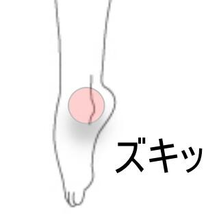 足関節捻挫