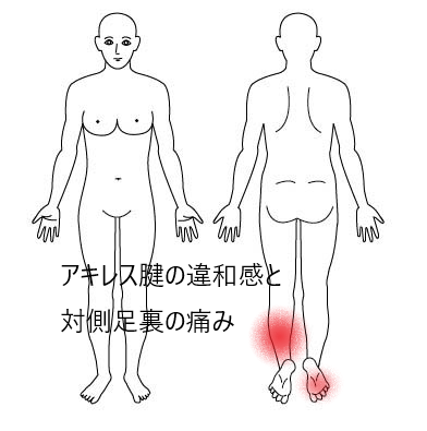 アキレス腱の違和感と対側
