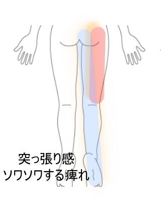 坐骨神経痛