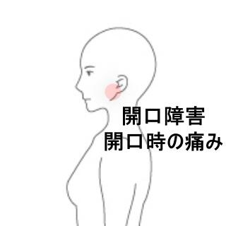 顎関節症