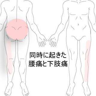腰痛下肢痛