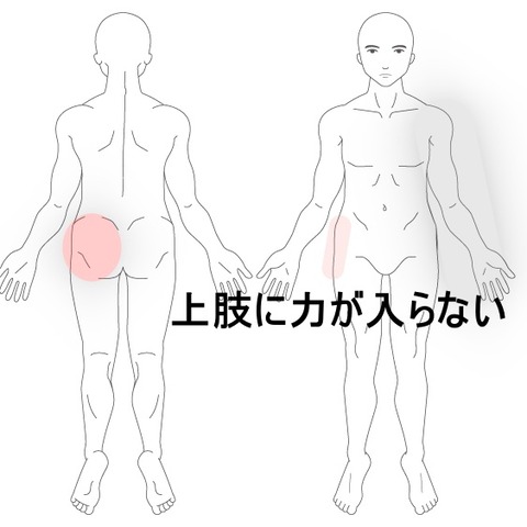 胸郭出口症候群
