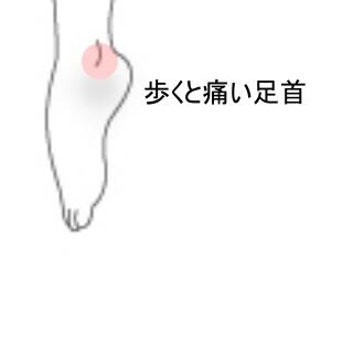 足首痛