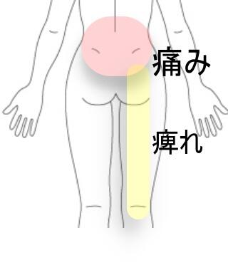 ヘルニア