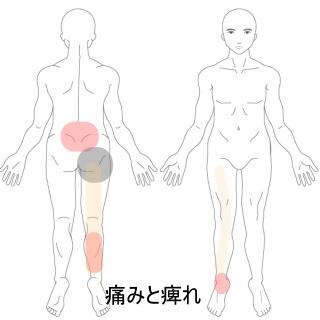 腰痛下肢痛