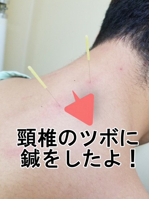 鍼 頸椎 up