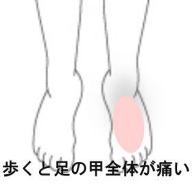 モートン病