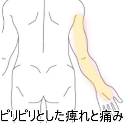 痺れ・痛み 1