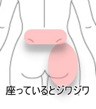 臀部痛 N