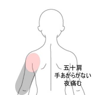 五十肩
