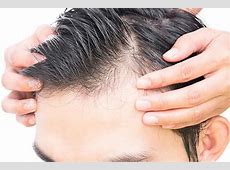 【速報】ハゲ薬塗り始め50日目俺、M字ハゲが解消してくる