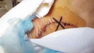 抜糸 グロ写真あり 注意 三毛ジャガーの物欲日記 抜糸 グロ写真あり 注意 三毛ジャガーの物欲日記