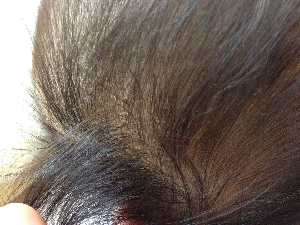 脂漏性湿疹 Sunny Style 脂漏性湿疹 Sunny Style