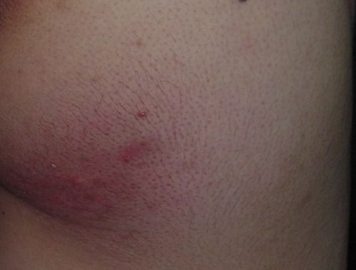 アトピー あせも様の湿疹がおしりに出ている 本人でも見えないところのケアはむずかしいです アトピーのモニターブログ 水で体質改善