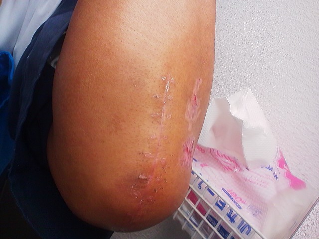 肘頭骨折 傷の様子 手術より１３日目 修行人 憩いの場