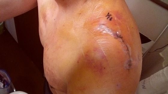 左鎖骨骨折 13日目 手術より5日目 通院3回目 修行人 憩いの場 左鎖骨骨折 13日目 手術より5日目 通院3回目 修行人 憩いの場