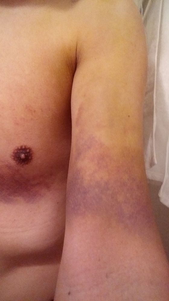 左鎖骨骨折 19日目 手術より11日目 修行人 憩いの場 左鎖骨骨折 19日目 手術より11日目 修行人 憩いの場