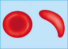 鎌状赤血球