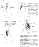 仙腸間接包内矯正