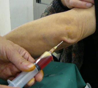 肘頭部滑液包炎 酒呑童子の随想録 肘頭部滑液包炎 酒呑童子の随想録