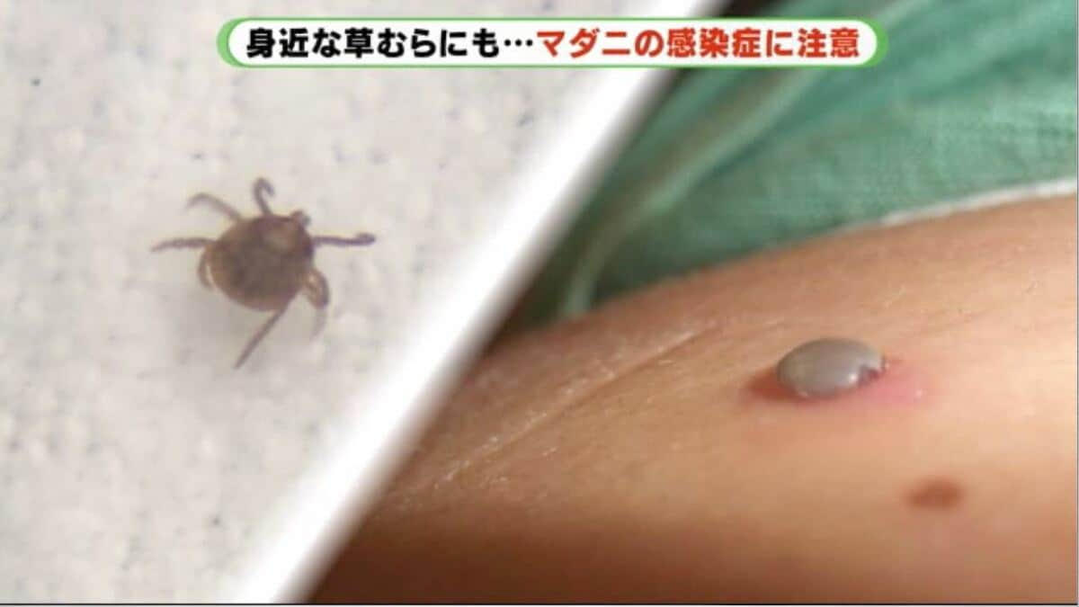 マダニによる感染症SFTS、国内初のヒトからヒト感染確認！ : すずめニュース！