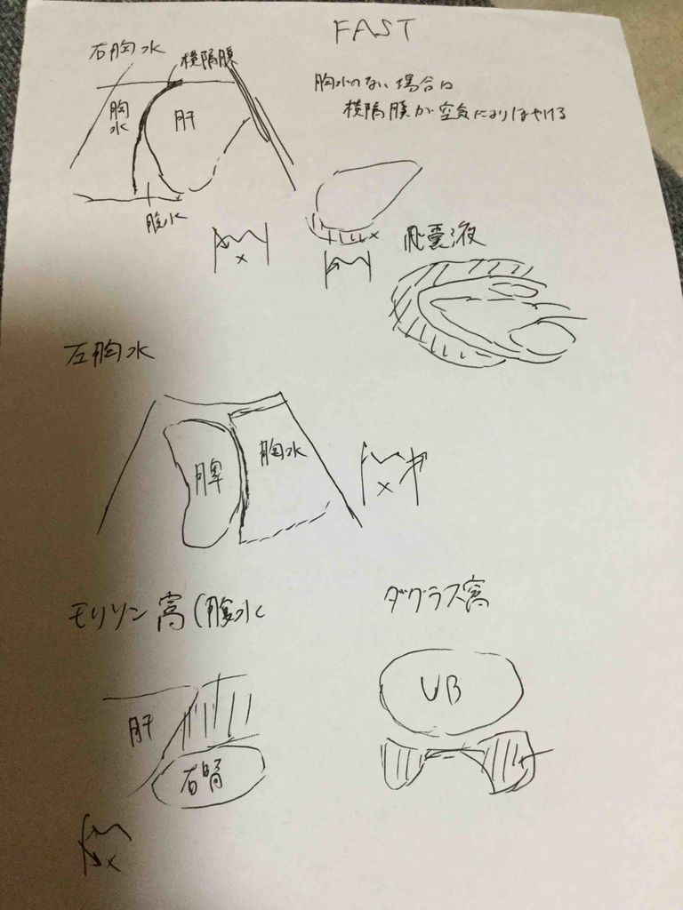 胸水 腹水の違いのノート 1記事3分 超音波検査士けんしんのエコーノート