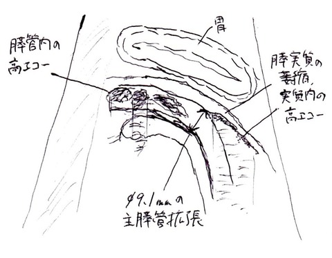 慢性膵炎