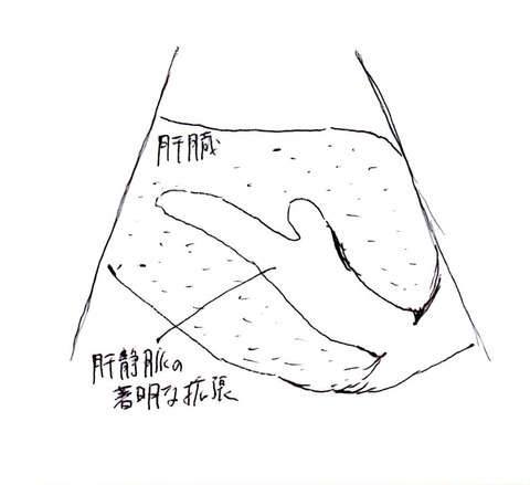 うっ血肝2