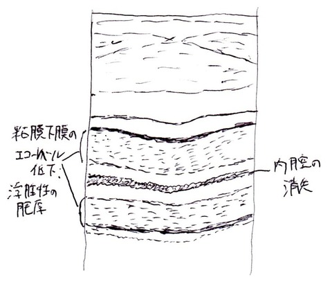 虚血性大腸炎
