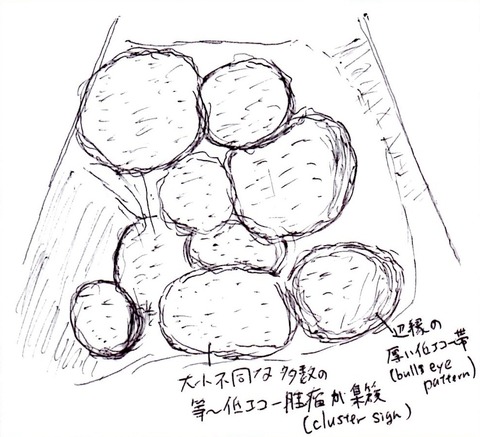 転移性肝細胞癌