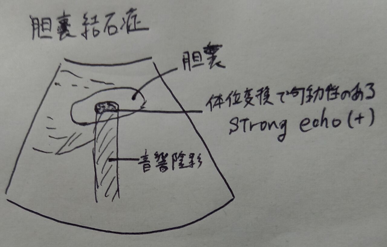胆嚢結石症 症例レポートの書き方のポイント 1記事3分 超音波検査士けんしんのエコーノート