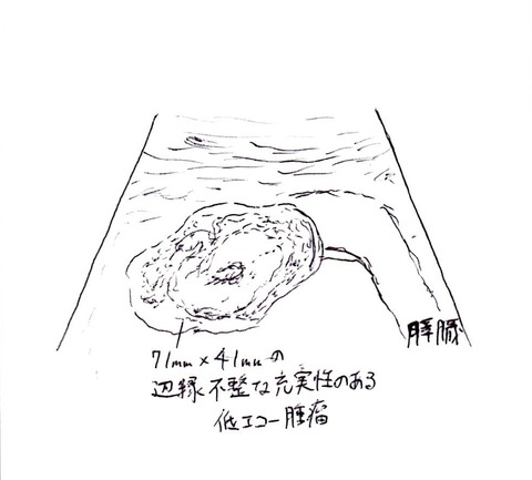 膵臓癌