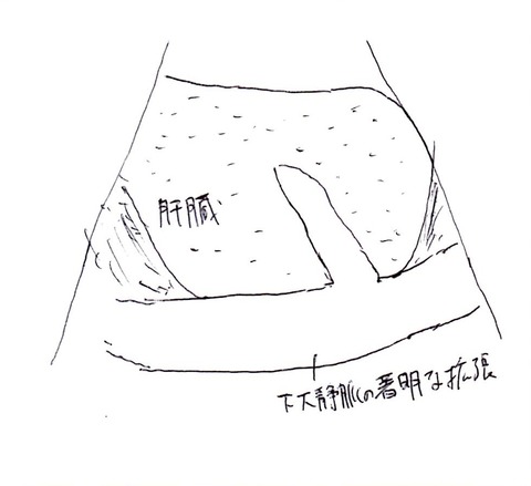うっ血肝1