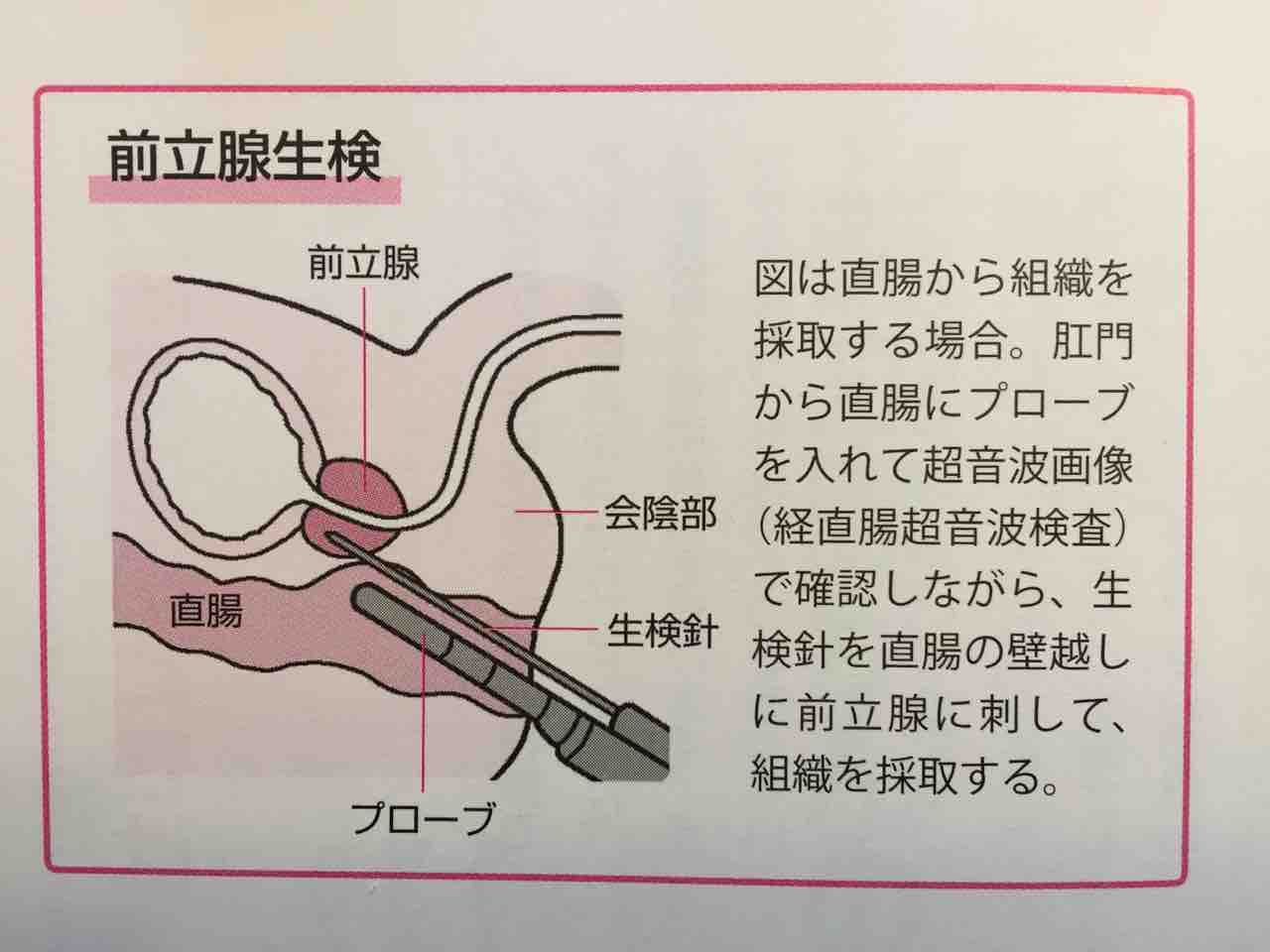 前立腺生検 癌と共存の日記