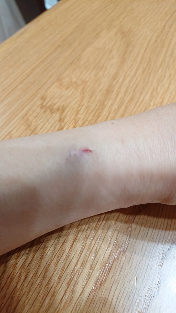 漏れ あざ 点滴