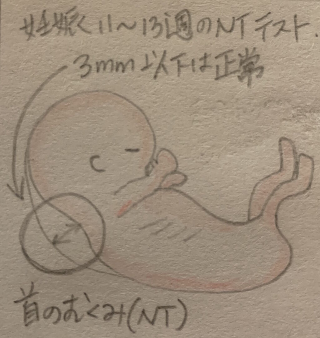 やな予感 首のむくみ Nt テスト アメリカで不妊治療36話 カリフォルニア子育て絵日記 やな予感 首のむくみ Nt テスト アメリカで不妊治療36話 カリフォルニア子育て絵日記
