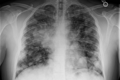 CHLAMYDIA-PNEUMONIA-NOT-COVID-19_large