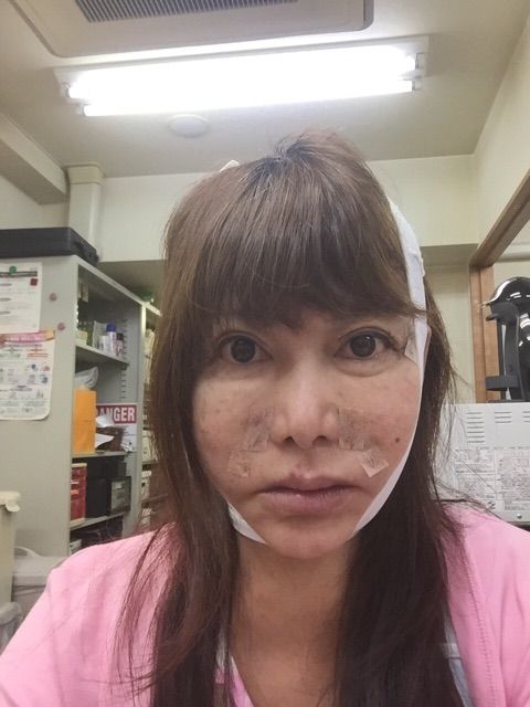 中村うさぎvsマッド髙梨 ガチblog 今回の手術で特筆すべきことは 眠らせてもらえなかったこと です ライブドアブログ 中村うさぎvsマッド髙梨 ガチblog 今回の手術で特筆すべきことは 眠らせてもらえなかったこと です ライブドアブログ