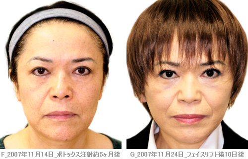 中村うさぎvsマッド髙梨 ガチblog 50歳からの美容整形 中村うさぎ ライブドアブログ